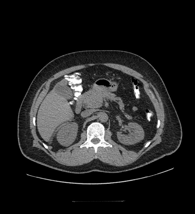 Chromophobe renal cell carcinoma (Radiopaedia 84337-99644 Axial non-contrast 34).jpg