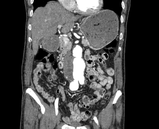 Chronic contained rupture of abdominal aortic aneurysm with extensive erosion of the vertebral bodies (Radiopaedia 55450-61901 D 22).jpg