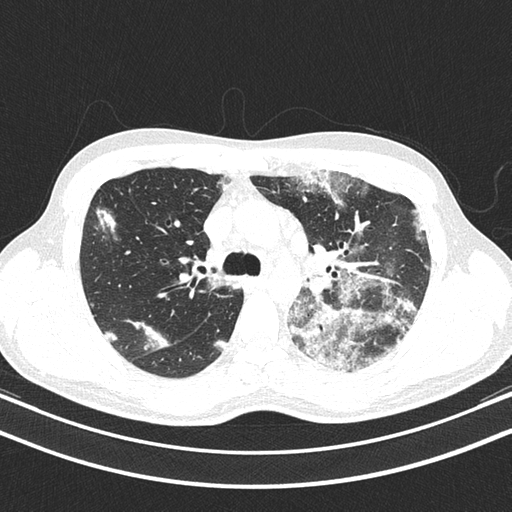 Chronic eosinophilic pneumonia (Radiopaedia 39331-41587 Axial lung window 18).png