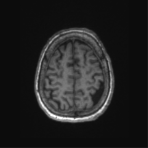 Chronic hypertensive encephalopathy (Radiopaedia 72844-83495 Axial T1 16).png