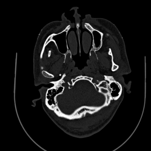 Chronic invasive fungal sinusitis (Radiopaedia 91563-109286 Axial sinus 8).jpg