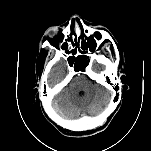 Chronic invasive fungal sinusitis (Radiopaedia 91563-109286 B 25).jpg