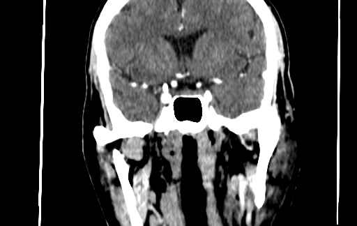 Chronic invasive fungal sinusitis (Radiopaedia 91563-109286 D 111).jpg