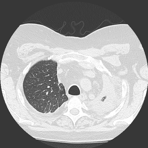Chronic lung allograft dysfunction - restrictive form (Radiopaedia 60595-68316 Axial lung window 14).jpg