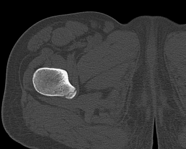 Chronic ostemyelitis of the femur with long sinus tract (Radiopaedia 74947-85982 Axial bone window 22).jpg