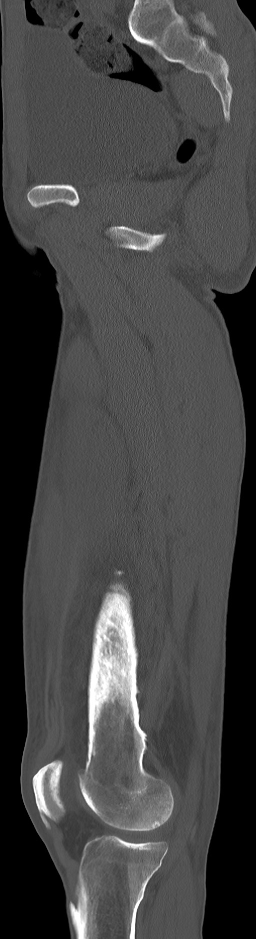 Chronic osteomyelitis (with sequestrum) (Radiopaedia 74813-85822 C 67).jpg