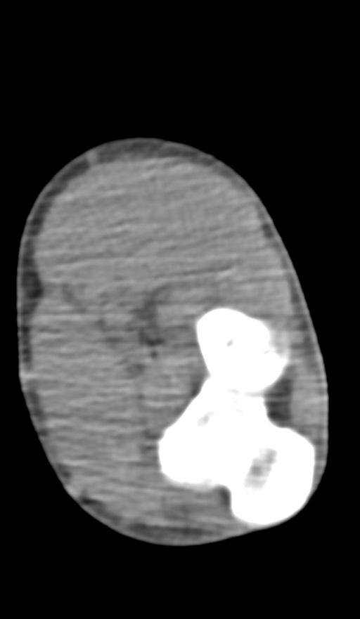 Chronic osteomyelitis of the distal humerus (Radiopaedia 78351-90971 Axial non-contrast 102).jpg