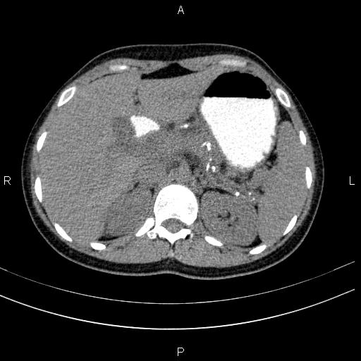 Chronic pancreatitis (Radiopaedia 64576-73450 Axial non-contrast 36).jpg