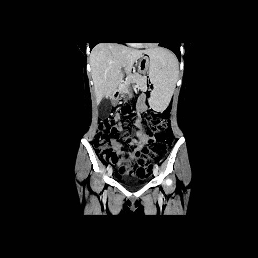Chronic portal venous thrombosis with cavernous transformation (Radiopaedia 73618-84398 B 54).jpg