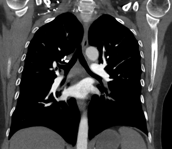 Chronic pulmonary embolus (Radiopaedia 39129-41341 Coronal C+ CTPA 50).png