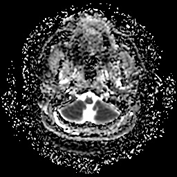 File:Chronic submandibular sialadenitis (Radiopaedia 61852-69885 Axial ADC 7).jpg