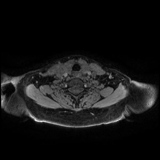 Chronic submandibular sialadenitis (Radiopaedia 61852-69885 Axial T1 C+ fat sat 3).jpg