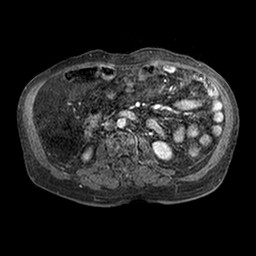 Cirrhosis and hepatocellular carcinoma in the setting of hemochromatosis (Radiopaedia 75394-86594 Axial T1 C+ fat sat 178).jpg