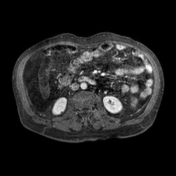 Cirrhosis and hepatocellular carcinoma in the setting of hemochromatosis (Radiopaedia 75394-86594 Axial T1 C+ fat sat 182).jpg