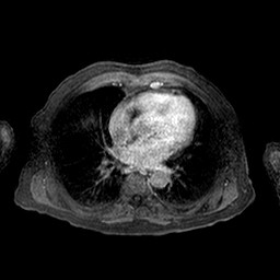 Cirrhosis and hepatocellular carcinoma in the setting of hemochromatosis (Radiopaedia 75394-86594 Axial T1 C+ fat sat 347).jpg
