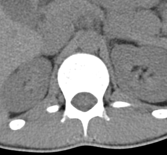 Clear cell meningoma - lumbar spine (Radiopaedia 60116-67691 Axial non-contrast 5).png