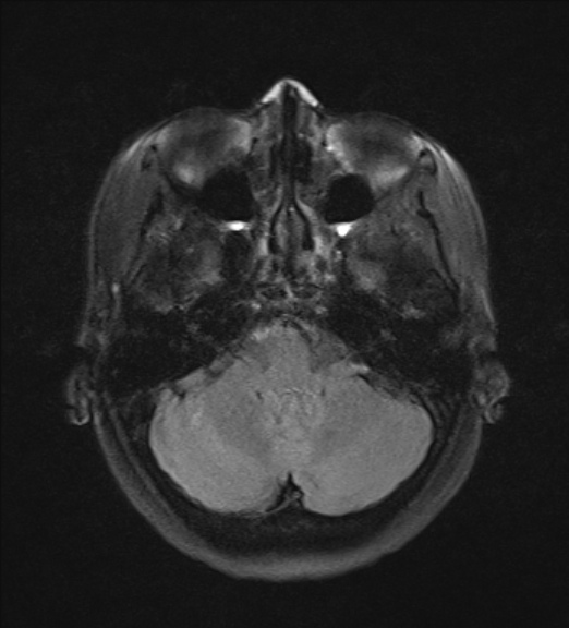 File:Clival meningioma (Radiopaedia 53278-59248 Axial FLAIR 5).jpg