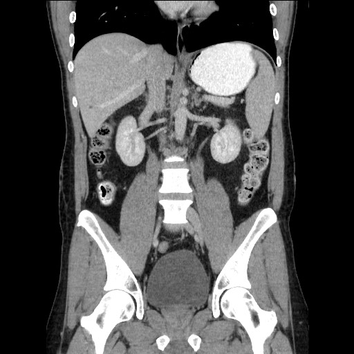 Closed-loop small bowel obstruction (Radiopaedia 73713-84509 C 70).jpg