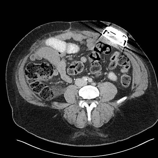 File:Closed loop obstruction - internal hernia into nephrectomy bed (Radiopaedia 59867-67320 Axial 32).jpg