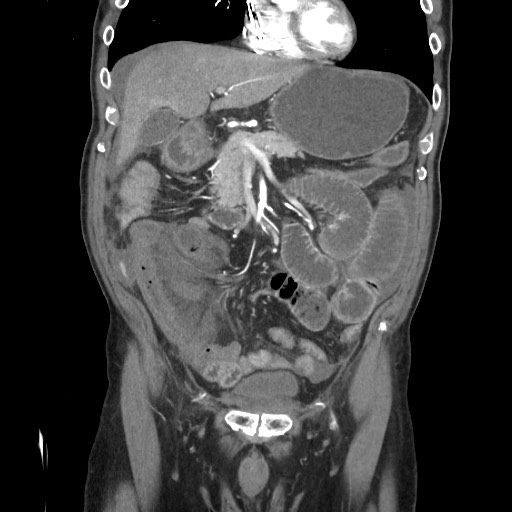 Closed loop obstruction due to adhesive band, resulting in small bowel ischemia and resection (Radiopaedia 83835-99023 C 48).jpg