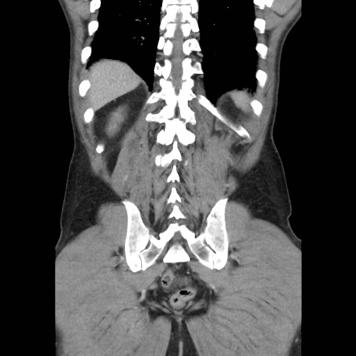 File:Closed loop small bowel obstruction (Radiopaedia 59227-66554 B 41).jpg