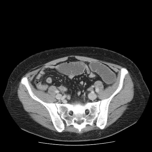 File:Closed loop small bowel obstruction (Radiopaedia 65403-74451 Axial 26).jpg