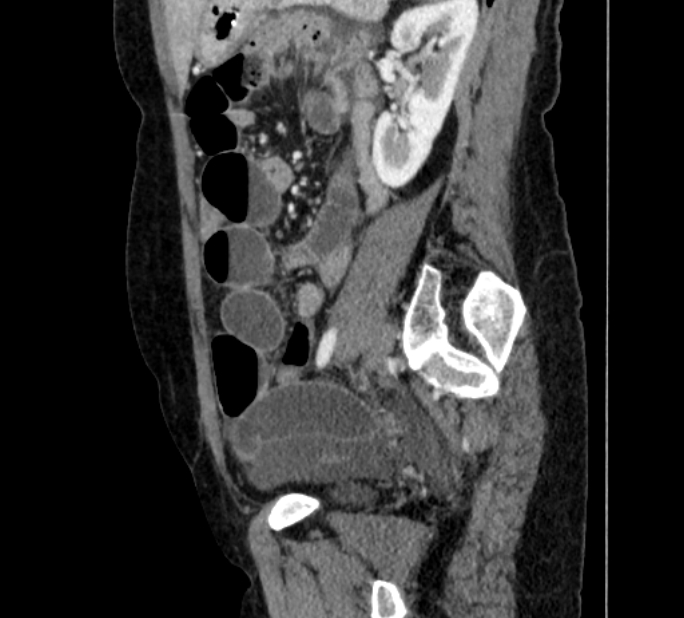 Closed loop small bowel obstruction (Radiopaedia 71211-81508 C 110).jpg