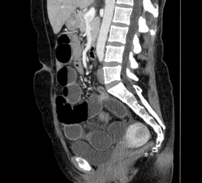 Closed loop small bowel obstruction (Radiopaedia 71211-81508 C 77).jpg