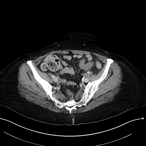 File:Closed loop small bowel obstruction - adhesions (Radiopaedia 59078-66369 Axial 54).jpg