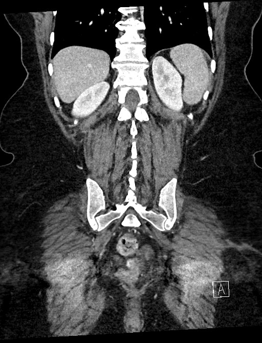 Closed loop small bowel obstruction - adhesions (Radiopaedia 59078-66369 B 96).jpg