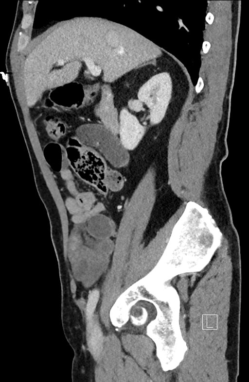 Closed loop small bowel obstruction - internal hernia (Radiopaedia 57806-64778 C 76).jpg