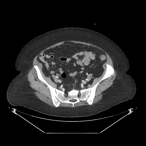 Closed loop small bowel obstruction - internal hernia (Radiopaedia 65402-74450 A 98).jpg