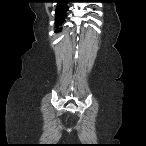 Closed loop small bowel obstruction - internal hernia (Radiopaedia 65402-74450 B 95).jpg