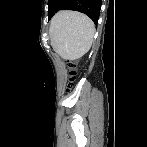 File:Closed loop small bowel obstruction - omental adhesion causing "internal hernia" (Radiopaedia 85129-100682 C 41).jpg