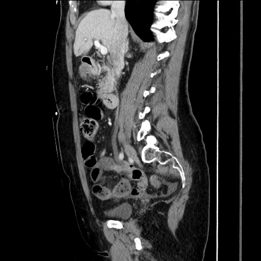 File:Closed loop small bowel obstruction due to adhesive bands - early and late images (Radiopaedia 83830-99014 C 80).jpg