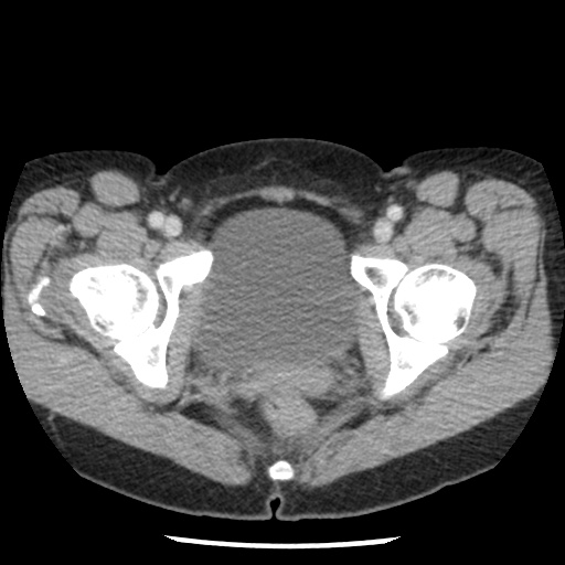 File:Closed loop small bowel obstruction due to trans-omental herniation (Radiopaedia 35593-37109 A 83).jpg