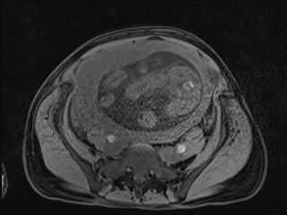 Closed loop small bowel obstruction in pregnancy (MRI) (Radiopaedia 87637-104031 F 33).jpg
