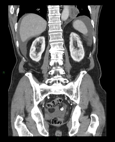 File:Closed loop small bowel obstruction with ischemia (Radiopaedia 84180-99456 B 18).jpg