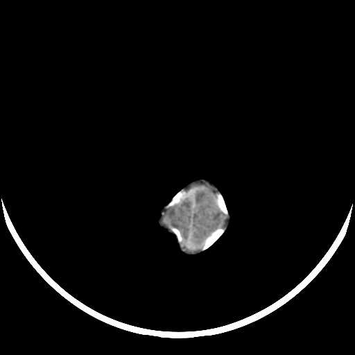 File:Cloverleaf shaped skull in the absence of craniosynostosis (Radiopaedia 21296-21216 Axial non-contrast 21).jpg
