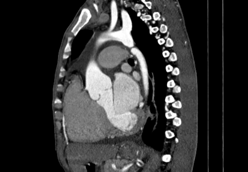 Coarctation of aorta with aortic valve stenosis (Radiopaedia 70463-80574 B 84).jpg