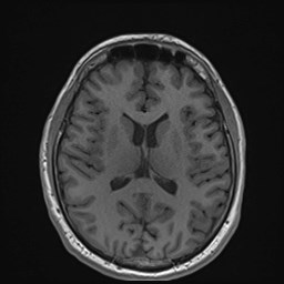 Cochlear incomplete partition type III associated with hypothalamic hamartoma (Radiopaedia 88756-105498 Axial T1 115).jpg