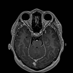 Cochlear incomplete partition type III associated with hypothalamic hamartoma (Radiopaedia 88756-105498 Axial T1 C+ 79).jpg