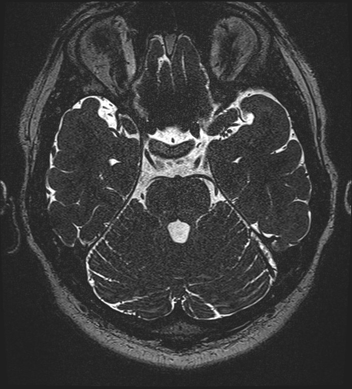 Cochlear incomplete partition type III associated with hypothalamic hamartoma (Radiopaedia 88756-105498 Axial T2 117).jpg