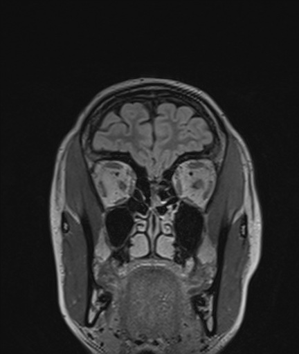 Colloid cyst (Radiopaedia 73154-83877 Coronal FLAIR 14).jpg