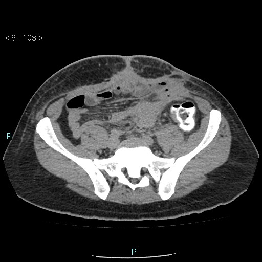 File:Colo-cutaneous fistula (Radiopaedia 40531-43129 A 42).jpg