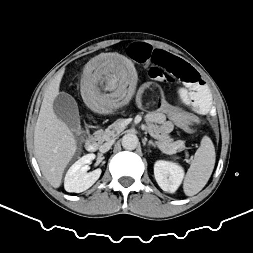 File:Colocolic intussusception due to large lipoma (Radiopaedia 68773-78482 A 59).jpg