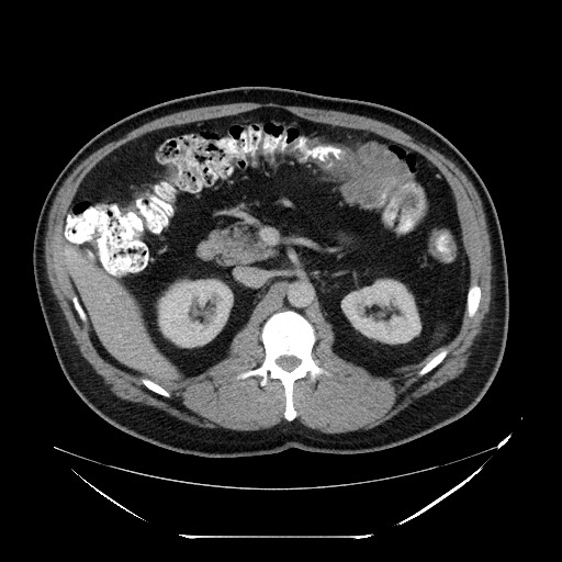 Colocolic intussusception due to lipoma (Radiopaedia 73712-84508 A 42).jpg
