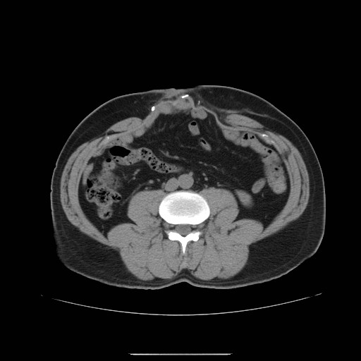 File:Colocutaneous fistula in Crohn's disease (Radiopaedia 29586-30093 Axial non-contrast 11).jpg