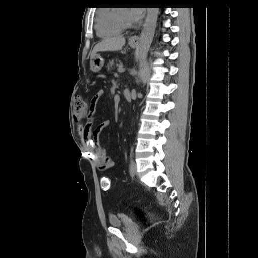 Colocutaneous fistula in Crohn's disease (Radiopaedia 29586-30093 F 22).jpg