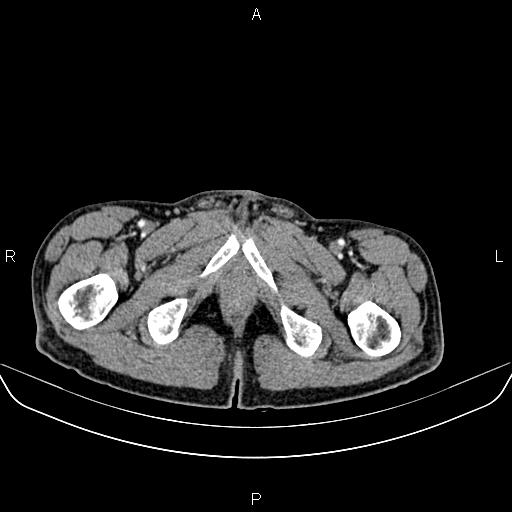 Colon adenocarcinoma - hepatic flexure (Radiopaedia 85635-101395 A 104).jpg